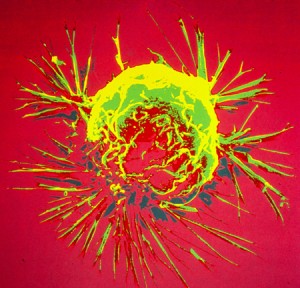 NCI-SEM-Picture-Breast-Cancer-Cell